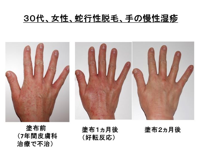 円形脱毛症　病院